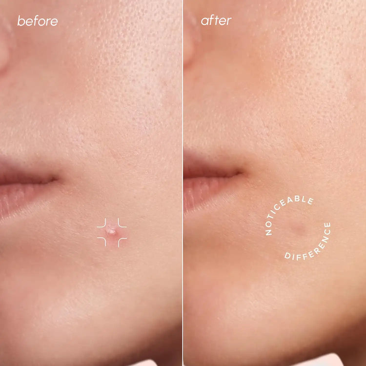 Set of Maree Invisible Pimple and Acne Patches in a Build Your Bundle package, designed to cover and treat blemishes discreetly.