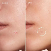 Set of Maree Invisible Pimple and Acne Patches in a Build Your Bundle package, designed to cover and treat blemishes discreetly.