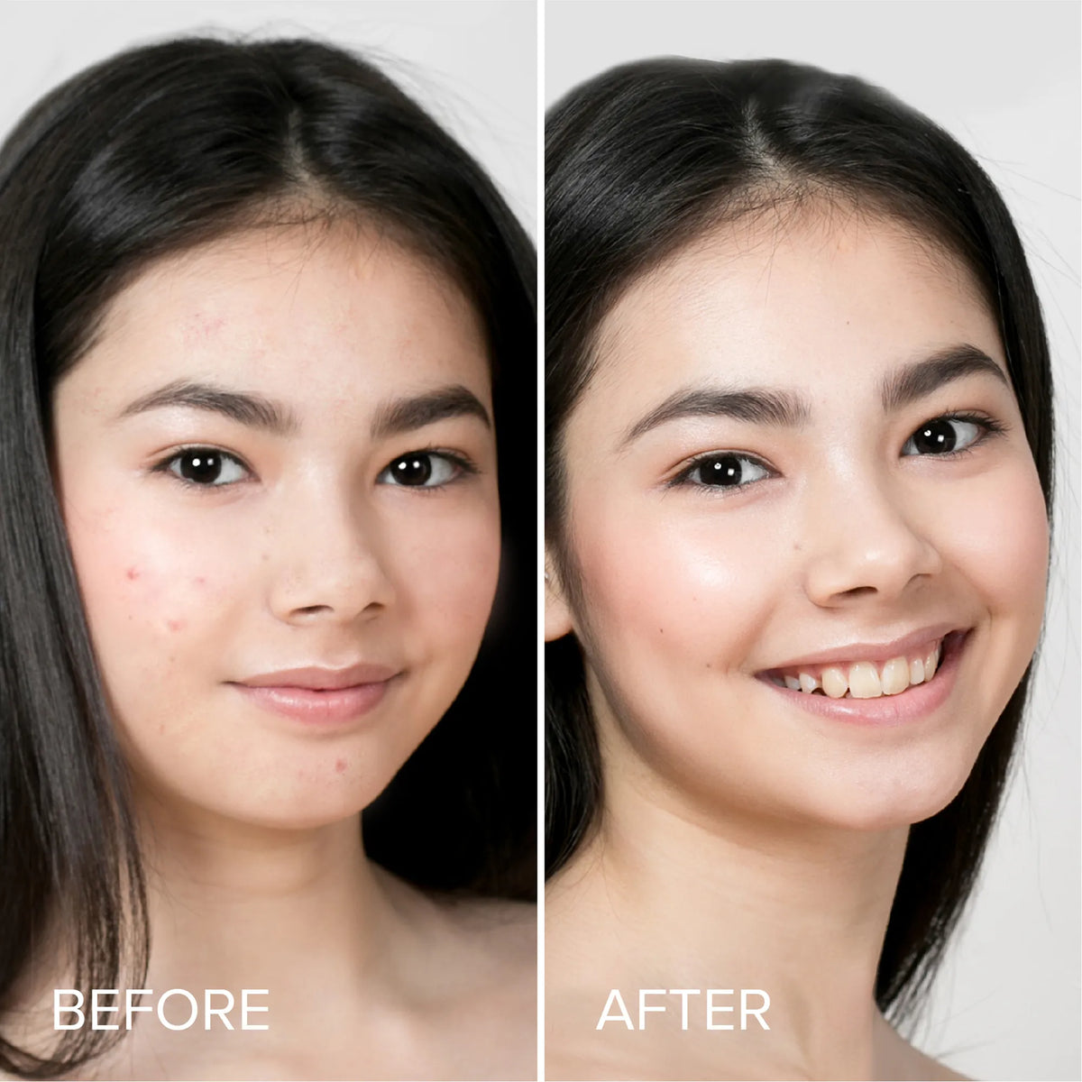 Maree pimple and acne patches on clear skin, showing their discreet, fast-acting design for blemish treatment and skin healing.