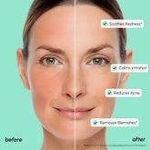 Maree Redness Soothing Azelaic Acid Serum in a clear glass dropper bottle, showing the serum inside, designed to reduce redness.
