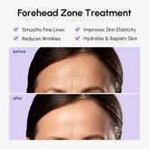 Maree anti-wrinkle forehead patches applied to smooth fine lines and wrinkles on the forehead.