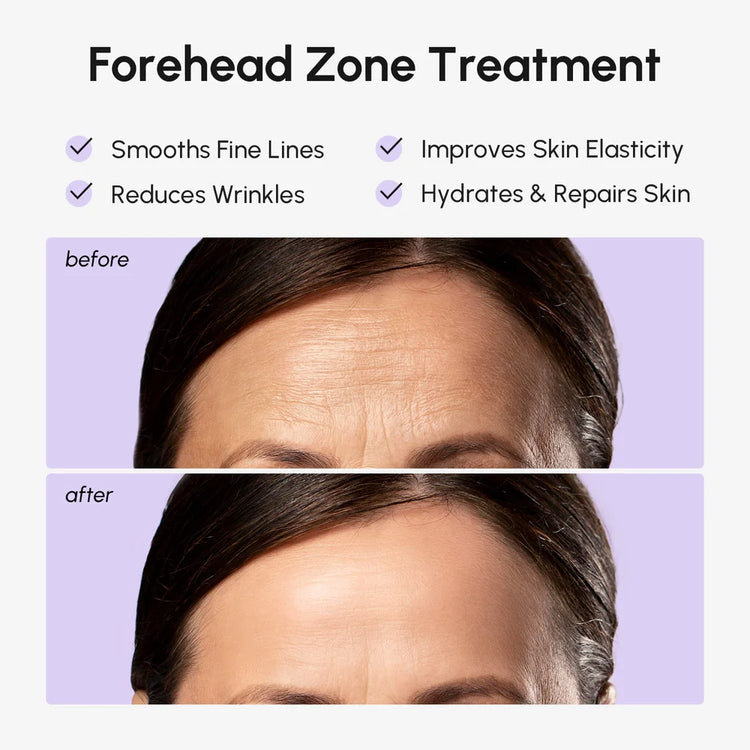 Maree anti-wrinkle forehead patches applied to smooth fine lines and wrinkles on the forehead.